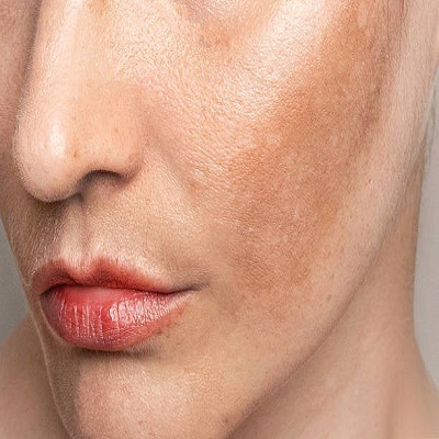 Say Goodbye to Dark Spots: Effective Skin Pigmentation Treatments in Riyadh